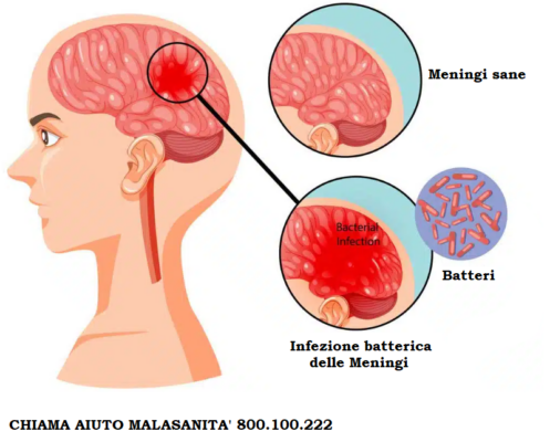 Meningite Neonatale